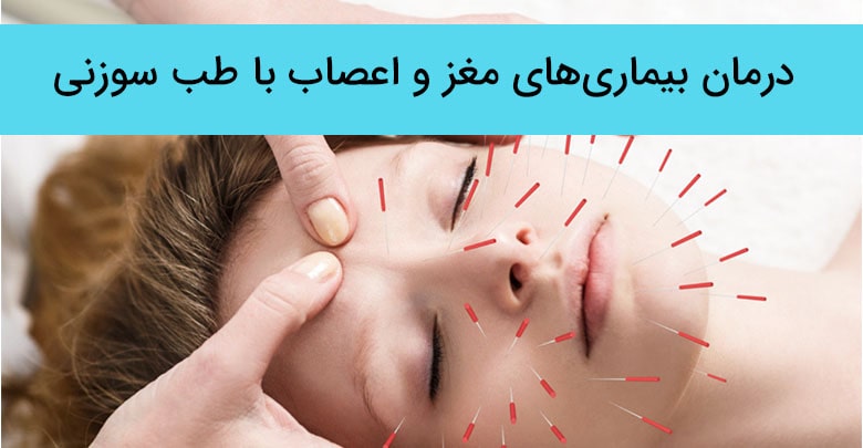 درمان اختلالات روانپزشکی با طب سوزنی