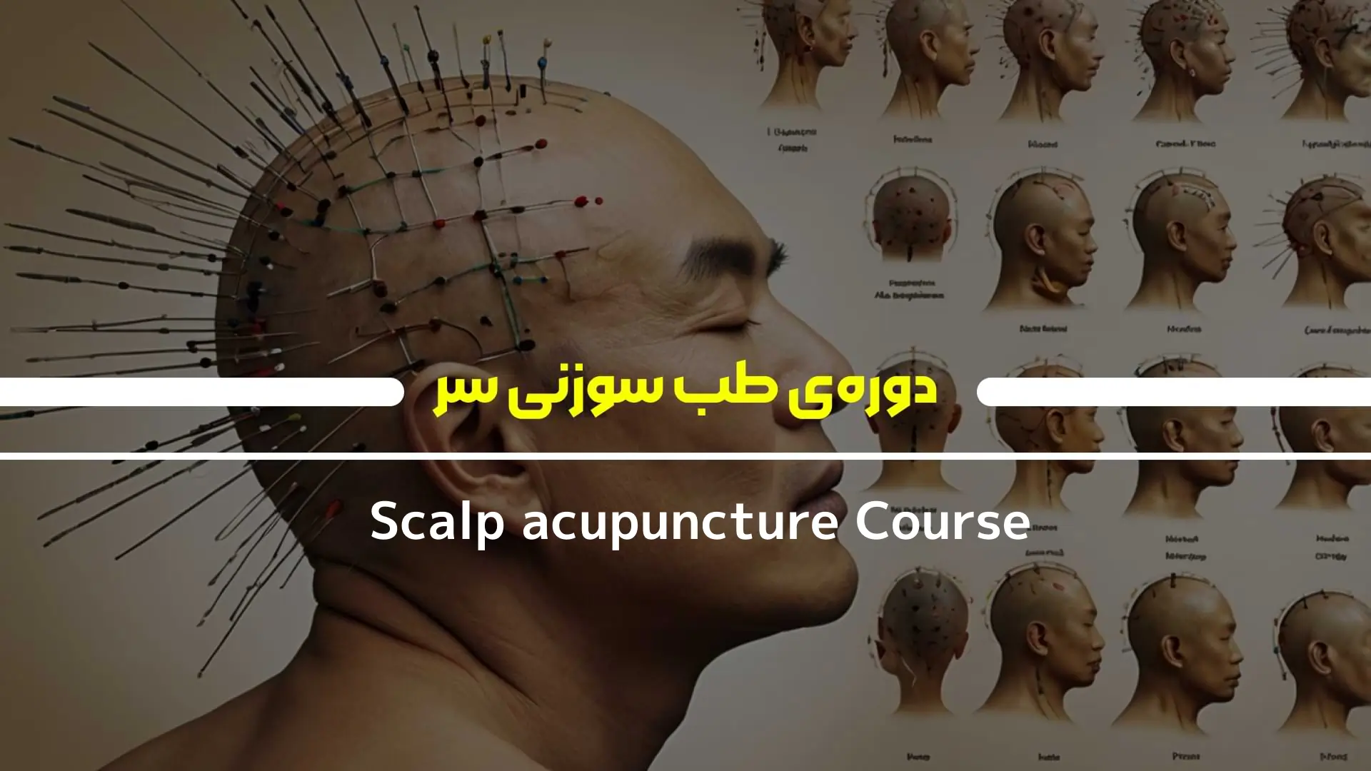 دوره‌ی طب سوزنی سر